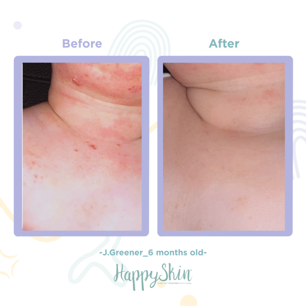 baby neck rashes image